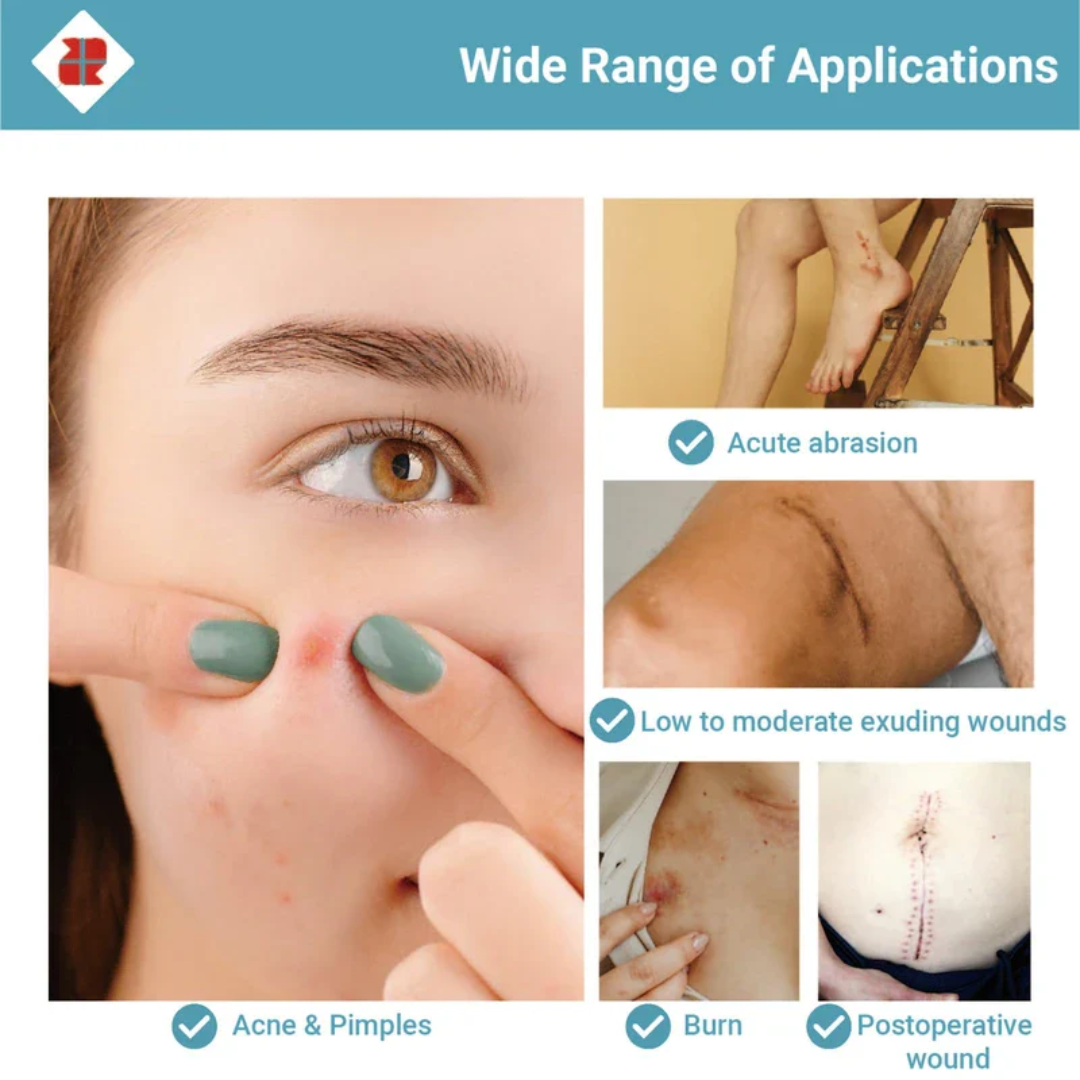 Hydrocolloid Roll for Acne, Bacne, Ezcema and wounds